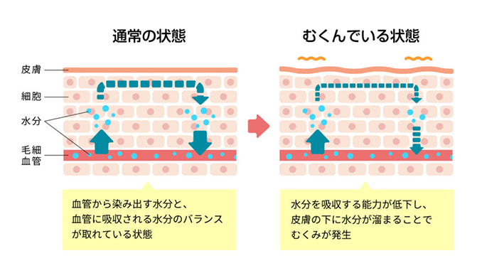 むくみの比較